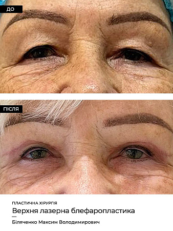 Блефаропластика нижних век фото до и после процедуры