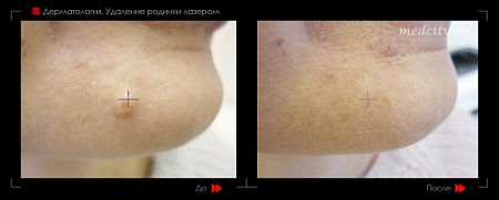 Удаление родинок18 фото до и после процедуры