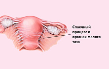 Спаечный процесс в малом тазу