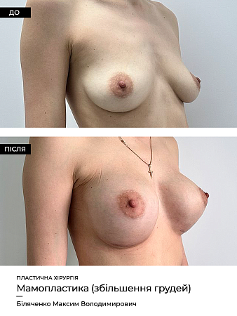 Маммопластика фото до и после процедуры