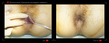 Удаление геморроя лазером 7 фото до и после процедуры