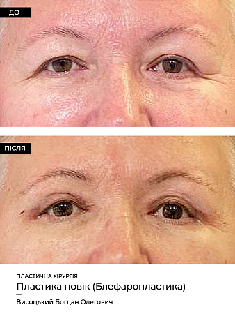 Блефаропластика фото до и после процедуры