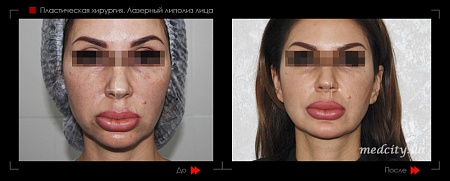 Липолиз лица 5 фото до и после процедуры