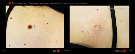Удаление родинки лазером фото до и после процедуры