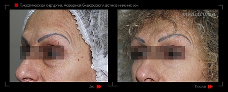 Блефаропластика нижнего века 4 фото до и после процедуры