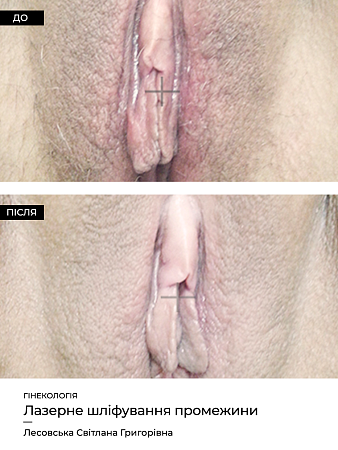 Лазерная фракционная шлифовка промежности 2 фото до и после процедуры