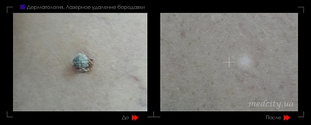 Лазерное удаление бородавок 12 фото до и после процедуры