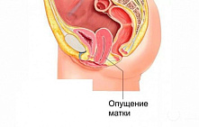 Опущение матки: симптомы и лечение