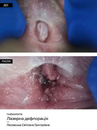 Дефлорация (иссечение перегородки девственной плевы) фото до и после процедуры