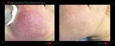 Фотолечение сосудов 2 фото до и после процедуры