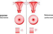 Лейкоплакия шейки матки
